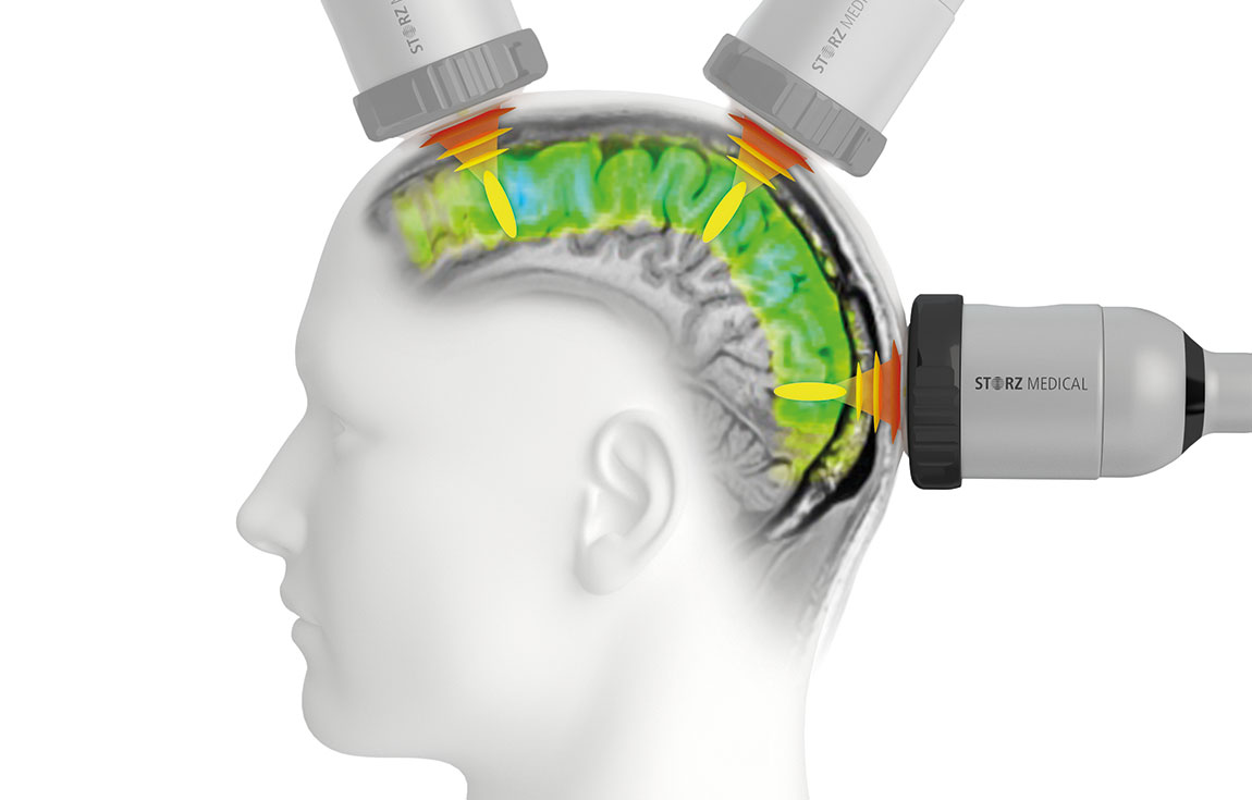 TPS® enables targeted stimulation of cerebral regions.