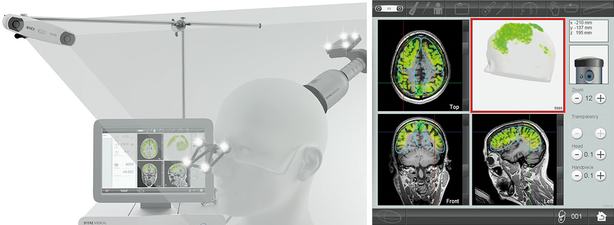 Real-time visualization of TPS® treatment