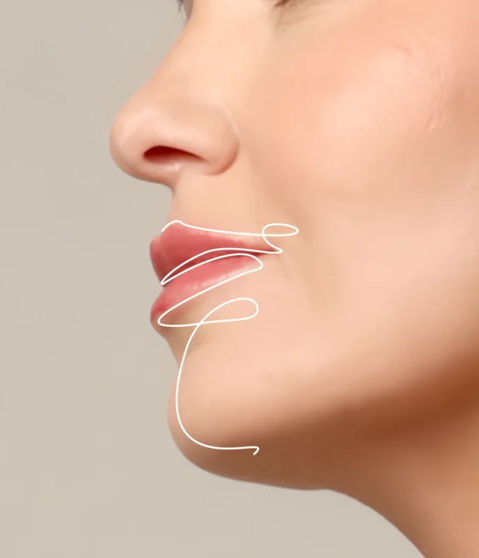 HYAcorp Lips hyaluronic acid for lip augmentation and hydration