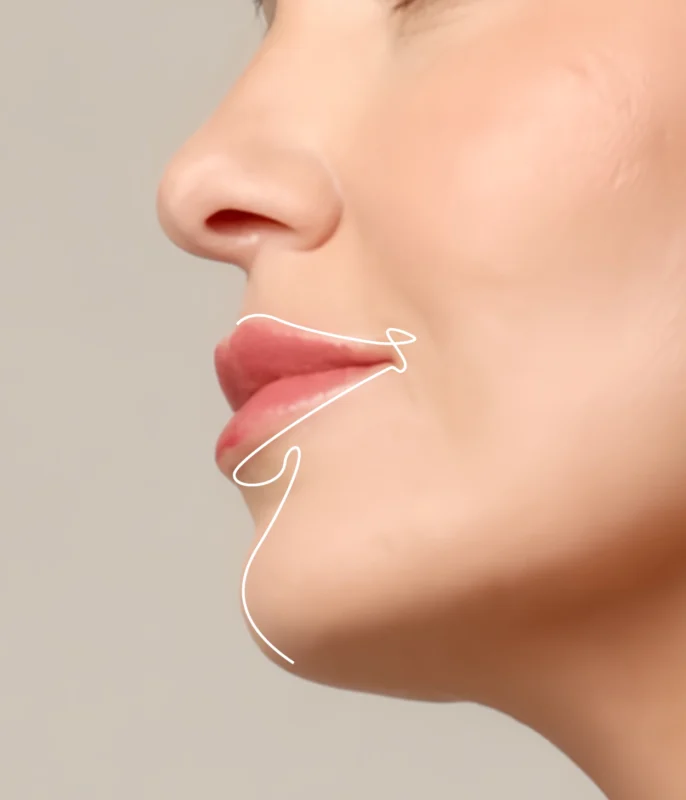 HYAcorp Lips hyaluronic acid for lip augmentation and hydration