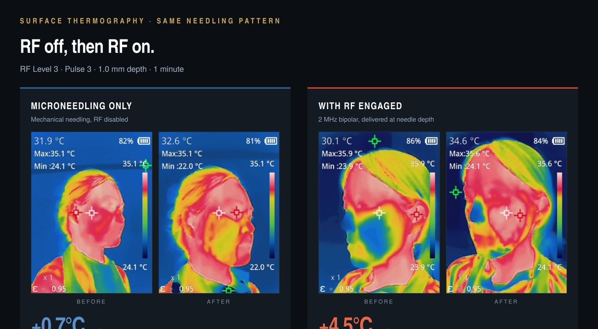 IDS REVAFLUX Thermal Coagulation Profile